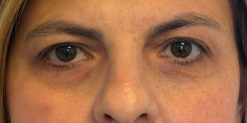 Blefaroplasti + Cerrahi Kaş Kaldırma — Öncesi
