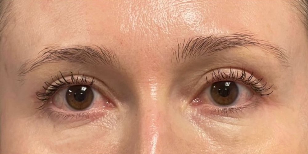 Üst Göz Kapağı Blefaroplasti — Sonrası